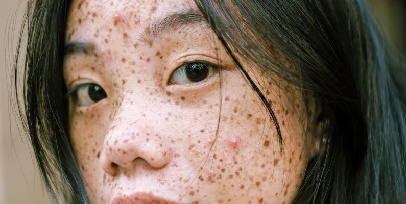 Spots - Close-Up Photography Of Woman's Face With Freckles